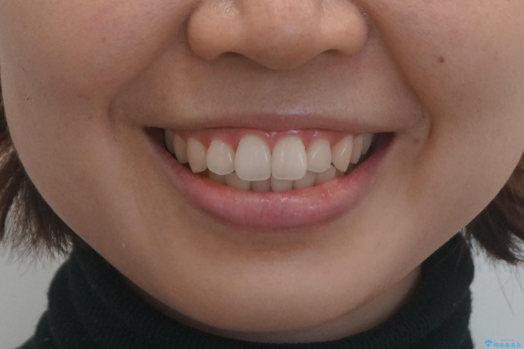 インビザライン モニターで前歯をきれいにの治療前(顔貌)