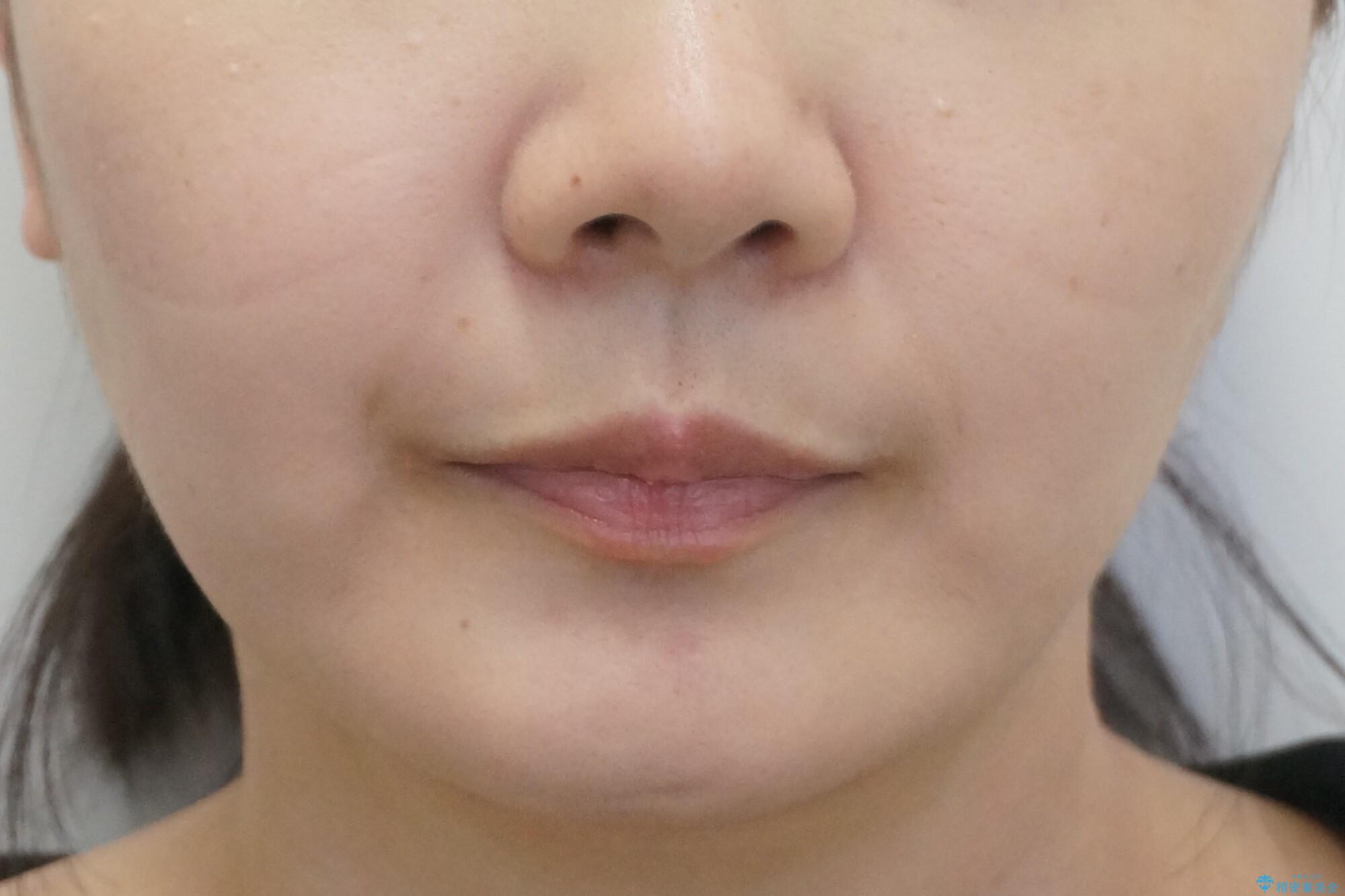 【難症例】歯並びが悪く、虫歯の治療ができない 矯正治療からスタートの治療後(顔貌)