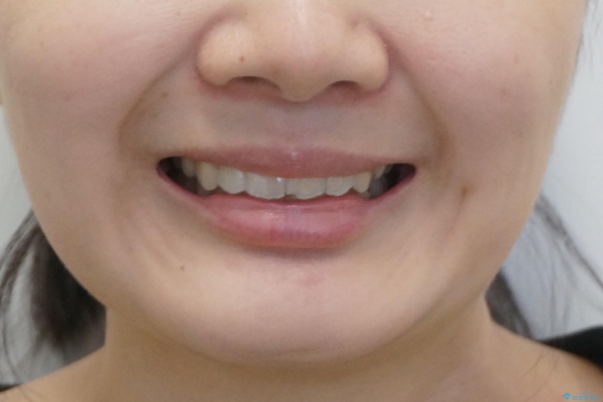 【難症例】歯並びが悪く、虫歯の治療ができない　矯正治療からスタートの治療後（顔貌）