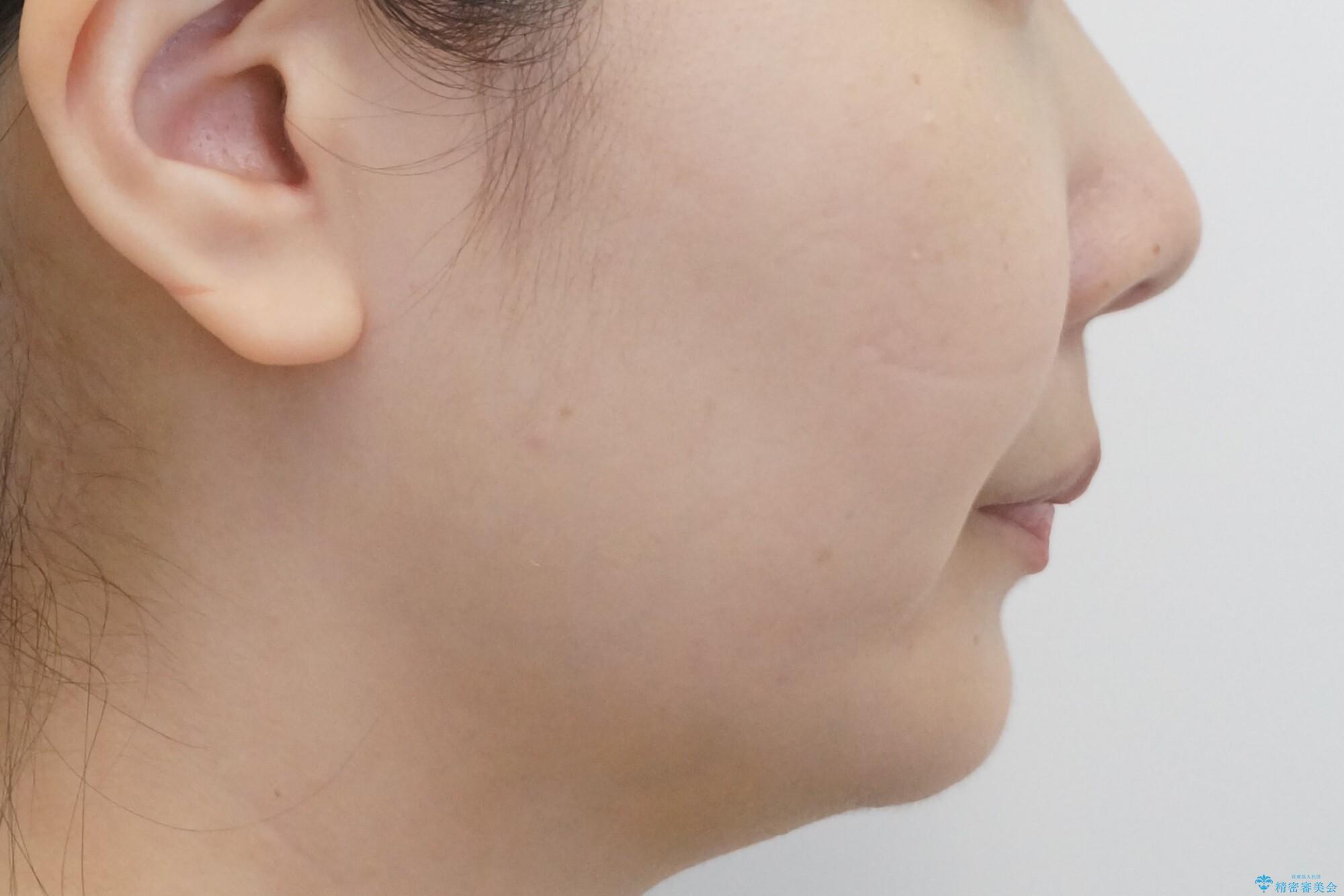 【難症例】歯並びが悪く、虫歯の治療ができない 矯正治療からスタートの治療後(顔貌)