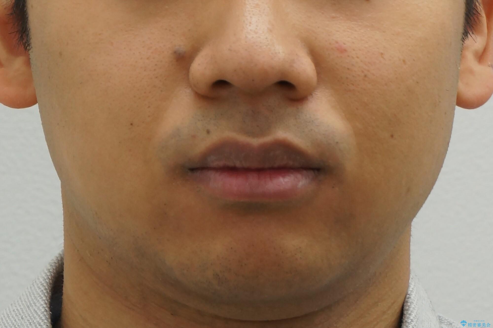 出っ歯を治したい 深いかみあわせ インビザラインで治療の治療前(顔貌)