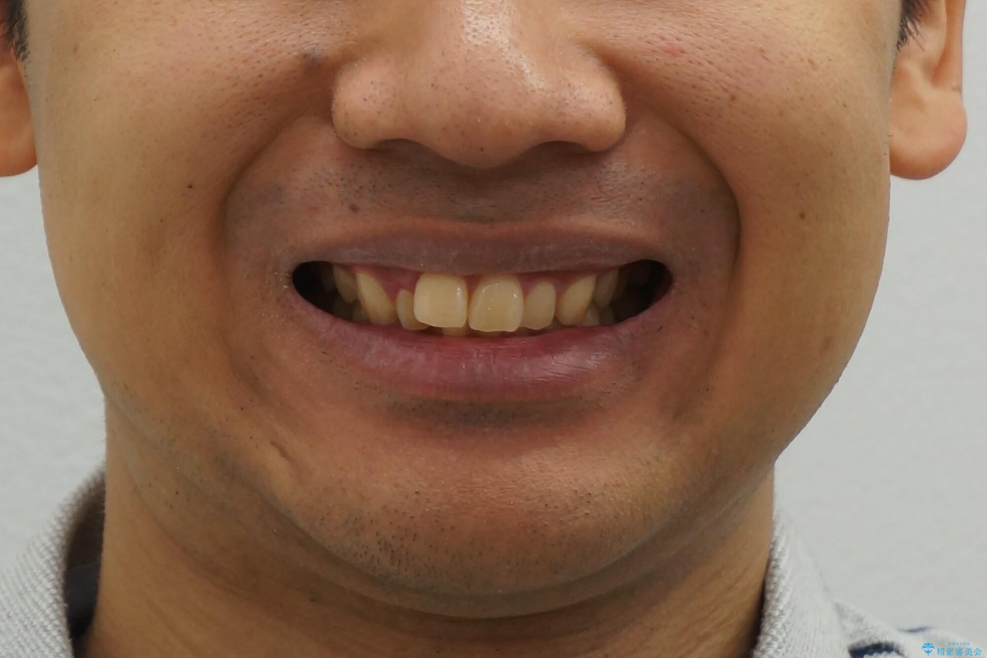 出っ歯を治したい　深いかみあわせ　インビザラインで治療の治療前（顔貌）