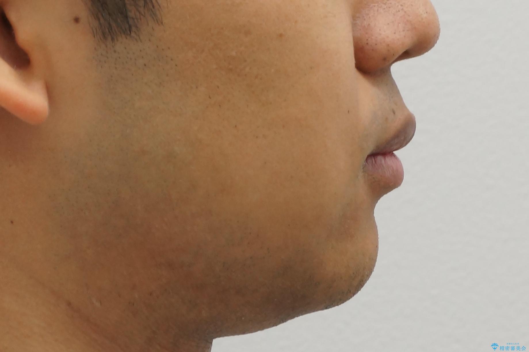 出っ歯を治したい 深いかみあわせ インビザラインで治療の治療前(顔貌)