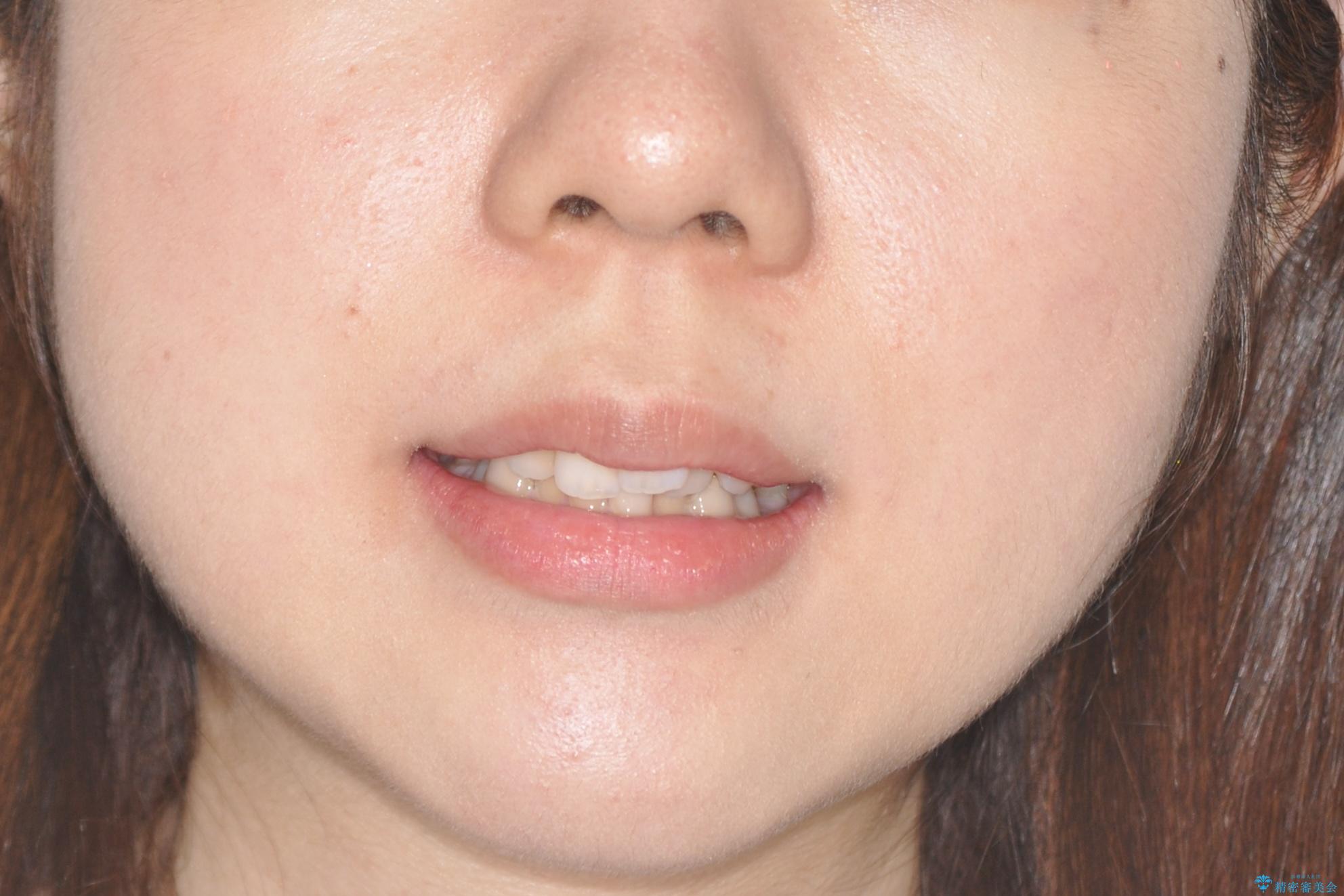 押しつぶされた歯列、アーチの拡大だけで非抜歯で改善した症例の治療前（顔貌）