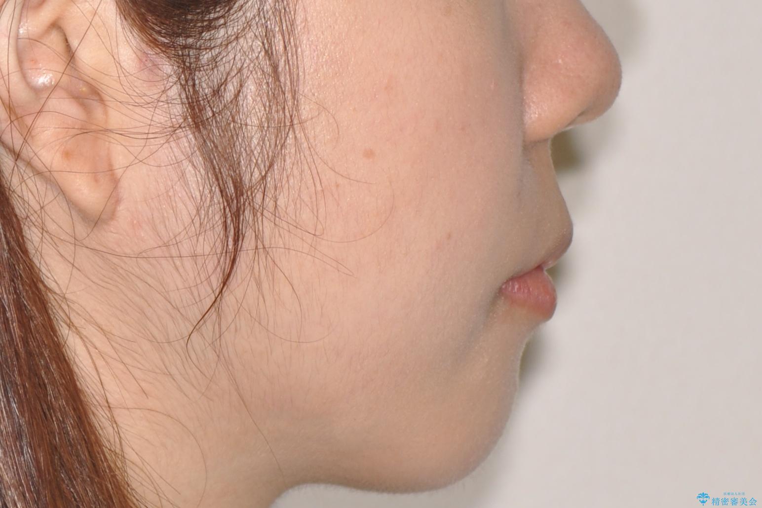 押しつぶされた歯列、アーチの拡大だけで非抜歯で改善した症例の治療前(顔貌)