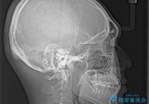 前歯のクロスバイトを改善 ワイヤー装置での非抜歯矯正の治療前