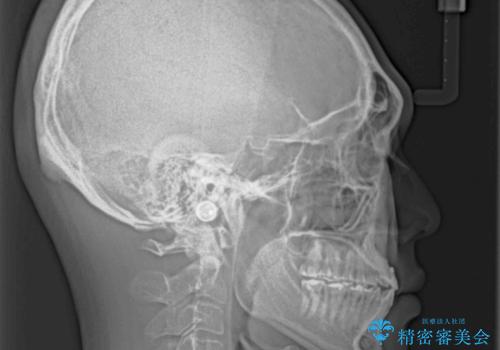 前歯のクロスバイトを改善 ワイヤー装置での非抜歯矯正の治療後