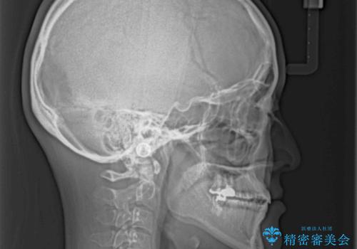 オープンバイトと前歯のデコボコをインビザライン矯正で解消の治療後