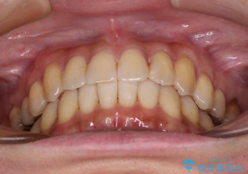 リスク回避 ワイヤー矯正を併用したインビザライン矯正治療の治療後