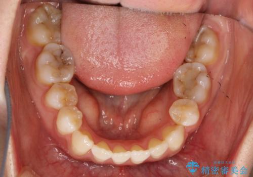 前歯がガタガタで咬めない ワイヤーによる抜歯矯正で整った歯並びへの治療後