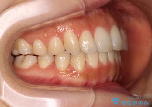 カリエールディスタライザーを併用した、咬み合わせ改善のインビザライン矯正の治療中