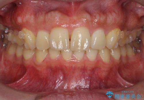 出っ歯を治したい 深いかみあわせ インビザラインで治療の治療中