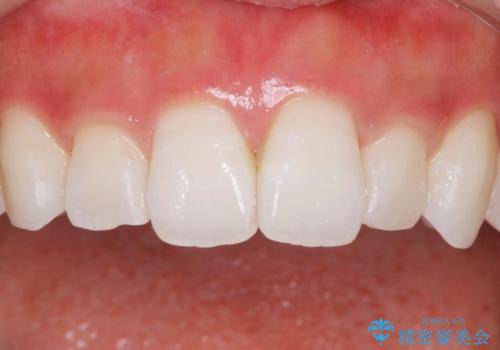 ホワイトニングスペシャルコースの治療後