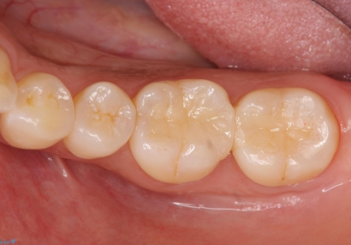 奥歯の虫歯　セラミックのつめものでやりかえの症例 治療後