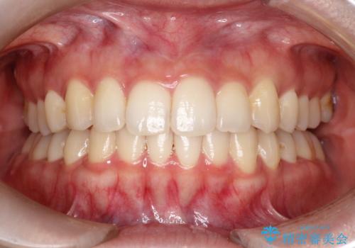前歯のがたがた気になる　インビザラインによる矯正治療の症例 治療後