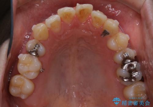 再矯正症例　前歯のガタガタと噛み合わせのズレをマウスピースで治した症例の治療中