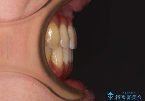 リスク回避 ワイヤー矯正を併用したインビザライン矯正治療の治療後