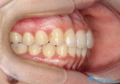 前歯のがたがた気になる インビザラインによる矯正治療の治療後