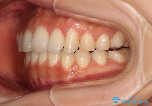 カリエールディスタライザーを併用した、咬み合わせ改善のインビザライン矯正の治療中