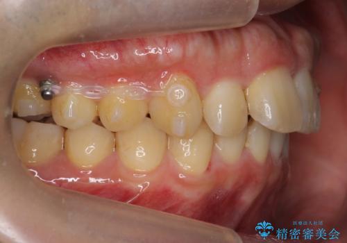 出っ歯を治したい 深いかみあわせ インビザラインで治療の治療中