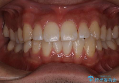 コーヒーの着色が前歯について目立つの治療後