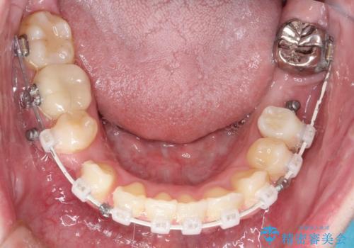 八重歯のワイヤーによる抜歯矯正　 矯正治療と並行してセラミック治療もの治療中