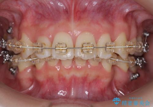 【難症例】歯並びが悪く、虫歯の治療ができない 矯正治療からスタートの治療中