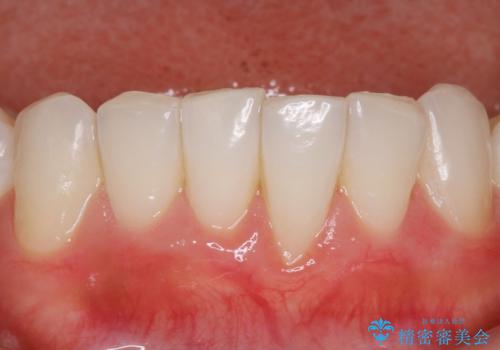 ホワイトニングスペシャルコースの治療後