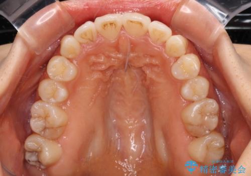 カリエールディスタライザーを併用した、咬み合わせ改善のインビザライン矯正の治療中