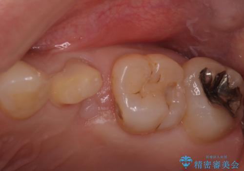 銀歯と歯の形が気になる　セラミックの治療中