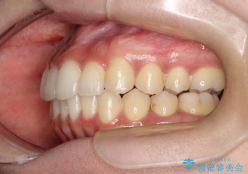 前歯のがたがた気になる インビザラインによる矯正治療の治療後