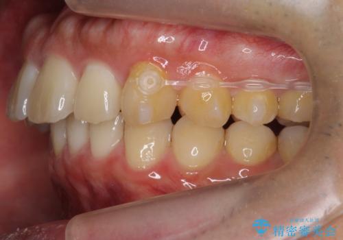 出っ歯を治したい 深いかみあわせ インビザラインで治療の治療中