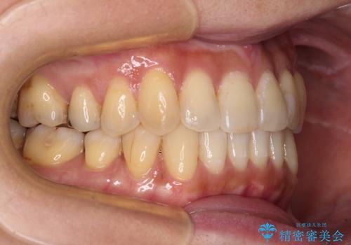 リスク回避 ワイヤー矯正を併用したインビザライン矯正治療の治療後
