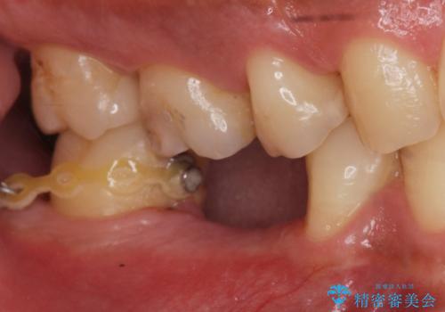 昔治療した銀歯を綺麗なセラミックに変えたい セラミックインレーの治療後