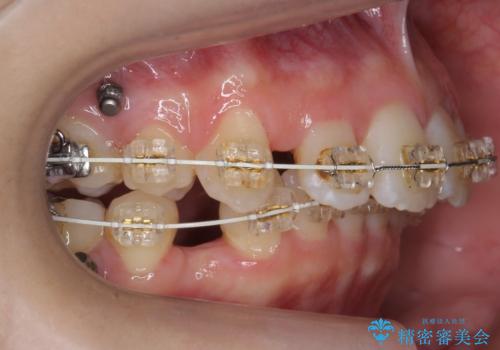 【難症例】歯並びが悪く、虫歯の治療ができない 矯正治療からスタートの治療中