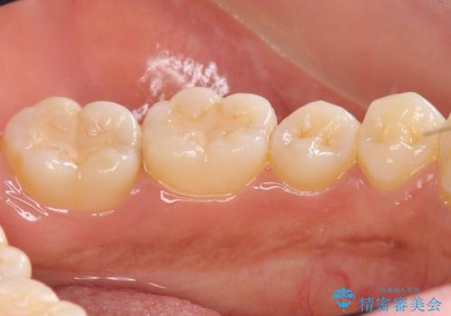 奥歯の虫歯 セラミックのつめものでやりかえの治療前