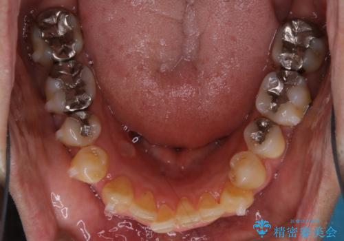 再矯正症例　前歯のガタガタと噛み合わせのズレをマウスピースで治した症例の治療中