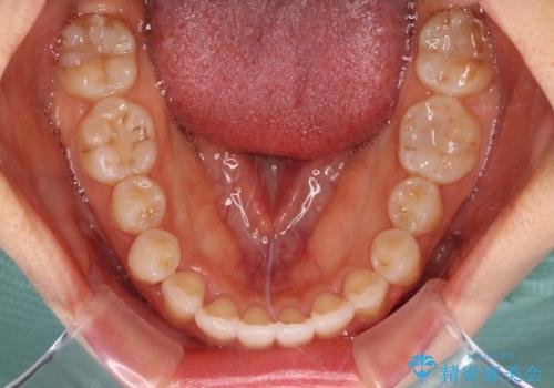 カリエールディスタライザーを併用した、咬み合わせ改善のインビザライン矯正の治療中