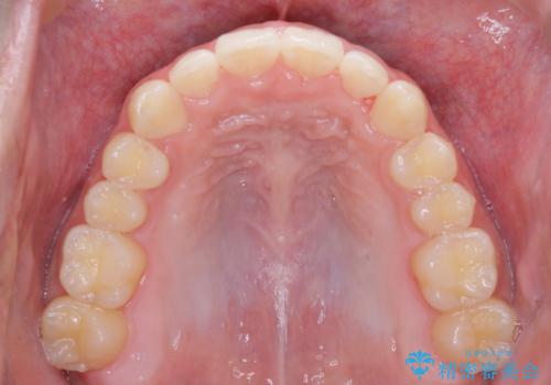 前歯が見えすぎる:インビザラインFULLで奥歯の噛み合わせも改善の治療後