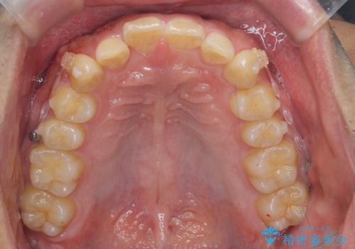 出っ歯を治したい 深いかみあわせ インビザラインで治療の治療中