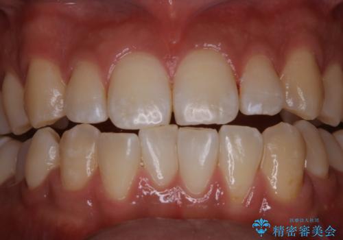 コーヒーの着色が前歯について目立つの治療後