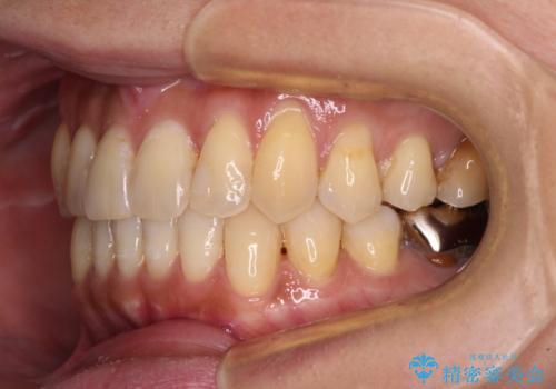 リスク回避 ワイヤー矯正を併用したインビザライン矯正治療の治療後