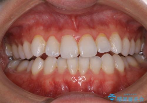 PMTC60分コースの治療前