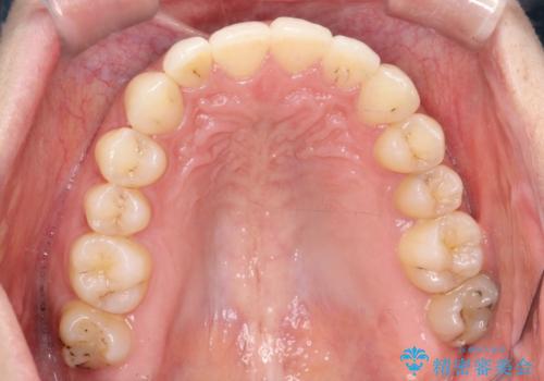 前歯のがたがた気になる インビザラインによる矯正治療の治療後