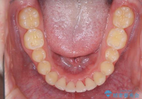 前歯が見えすぎる:インビザラインFULLで奥歯の噛み合わせも改善の治療後