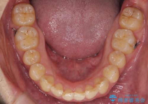 出っ歯を治したい 深いかみあわせ インビザラインで治療の治療中