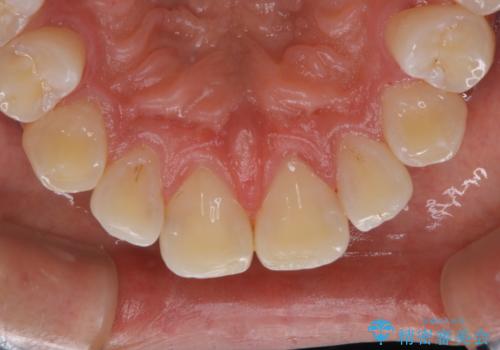 コーヒーの着色が前歯について目立つの治療後