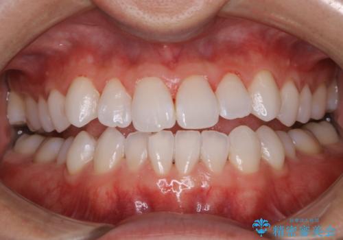 PMTC60分コースの治療後