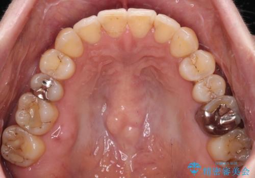 リスク回避 ワイヤー矯正を併用したインビザライン矯正治療の治療後