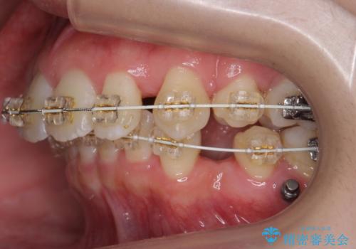 【難症例】歯並びが悪く、虫歯の治療ができない　矯正治療からスタートの治療中